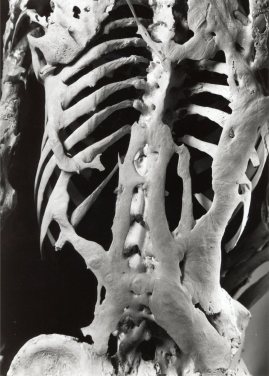 Skeleton with Fibrodysplasia Ossificans Progressiva, Mütter Museum