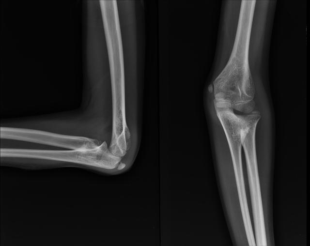 Radioulnar synostosis